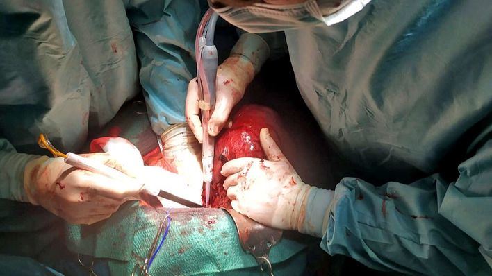 Extraen un tumor hepático gigante en Juaneda Hospitales
