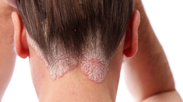 El 36 por ciento de los baleares con psoriasis no recibe ningún tipo de tratamiento