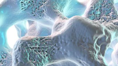 ¿Es la osteoporosis una enfermedad de mujeres?